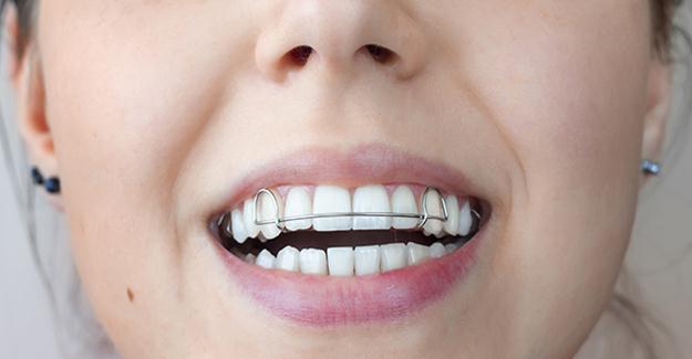 Diş tellerine alternatif tedavi: Şeffaf plak