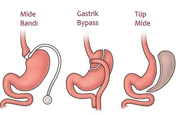 Tüp mide ameliyatı hakkında bilinmeyenler