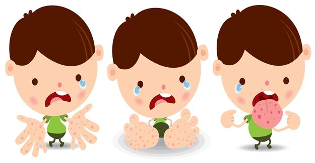 Çocuklarda el-ayak ve ağız hastalığı uyarısı