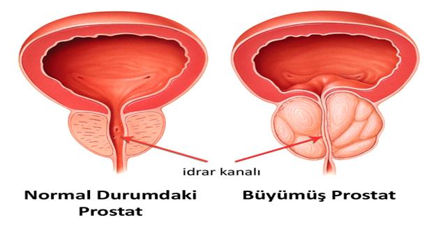 Prostatı olanlar kışa dikkat etmeli