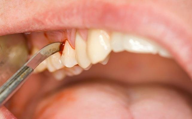 Diş eti kanamasına karşı düzenli ağız bakımı şart