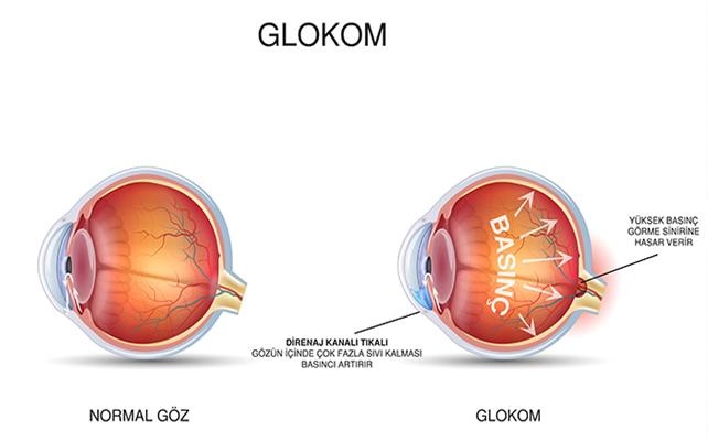 Glokom görme kaybına yol açıyor