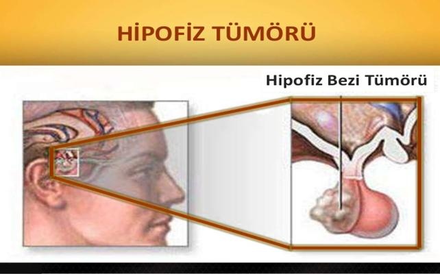 Her beş kişiden birinde hipofiz tümörü riski var