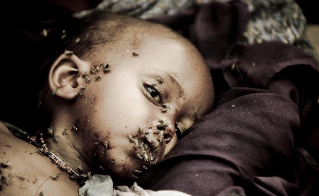 Somali’de 48 saatte 100 kişi açlıktan öldü