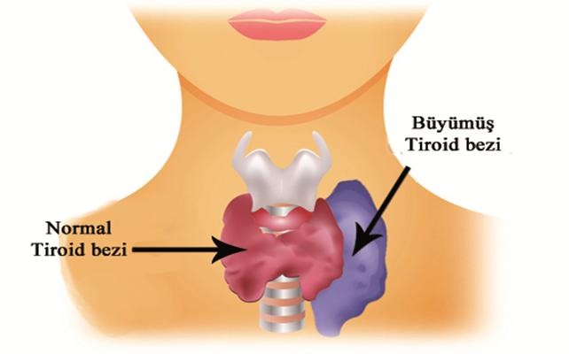 Tiroid hastalığının 13 belirtisi