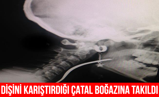 Dişini Karıştırdığı Çatal Boğazına Takıldı