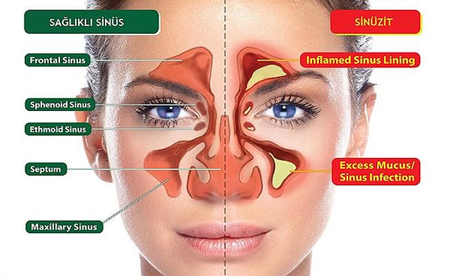 Sinüzit'i Olanlar Dikkat Etmeli