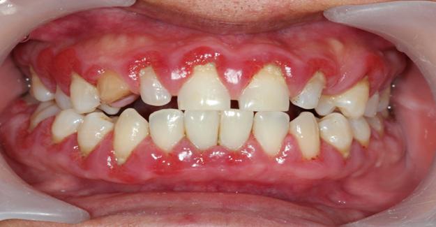 Diş Eti Hastalıkları Neden Oluşur ?
