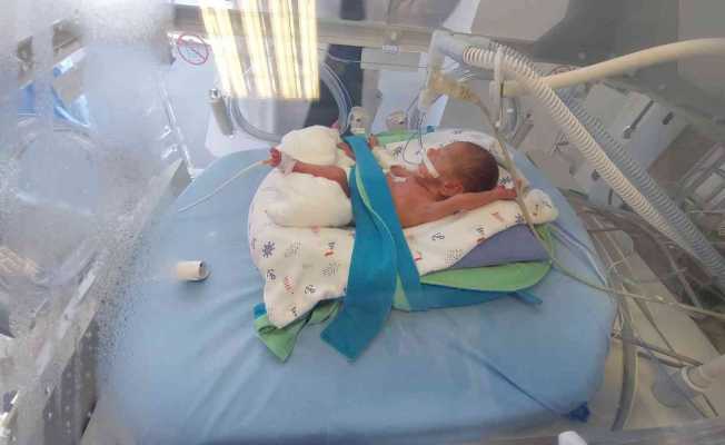 495 gramlık prematüre bebeğe kök hücre nakli yapıldı