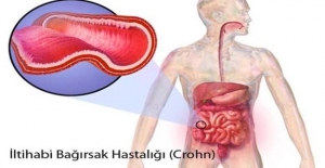 ‘Crohn hastalığı’ bağırsak sağlığını bozuyor