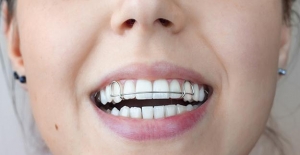 Diş tellerine alternatif tedavi: Şeffaf plak
