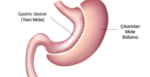 Kapalı tüp mide ameliyatı obeziteye çare oluyor