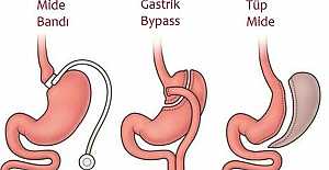 Tüp mide ameliyatı hakkında bilinmeyenler