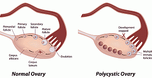 Her 10 kadından birinin sorunu: polikistik over sendromu