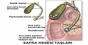 Safra yolu taşlarına kısa sürede ameliyatsız çözüm