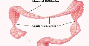 Beş kişiden biri bu hastalığa yakalanıyor