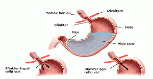 Mide reflüsünün bir uzantısı, boğaz reflüsü