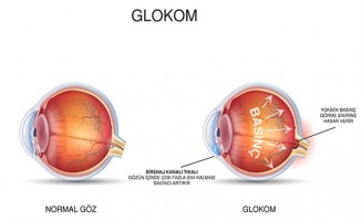 Glokom görme kaybına yol açıyor