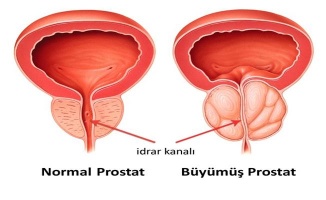 "İyi huylu prostat büyümesi böbrek yetmezliğine neden olabilir"