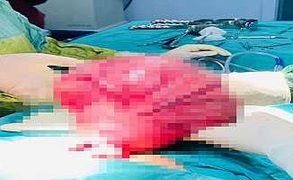 Siirt'te bir kadının karnından 4 kilogramlık kitle çıktı